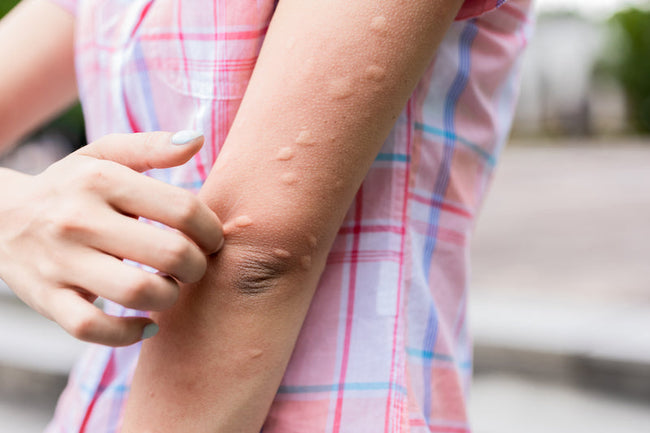 Is it Allergies or Histamine Intolera...